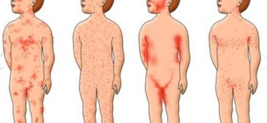 Кір і вітрянка: ключові відмінності та характеристики захворювань