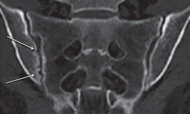 Сакроілеїт: причини, симптоми та ефективні методи лікування патології