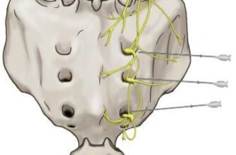 Двобічний сакроілеїт: симптоми, діагностика та лікування захворювання