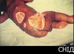 Що таке СНІД: Причини, симптоми та методи профілактики та лікування