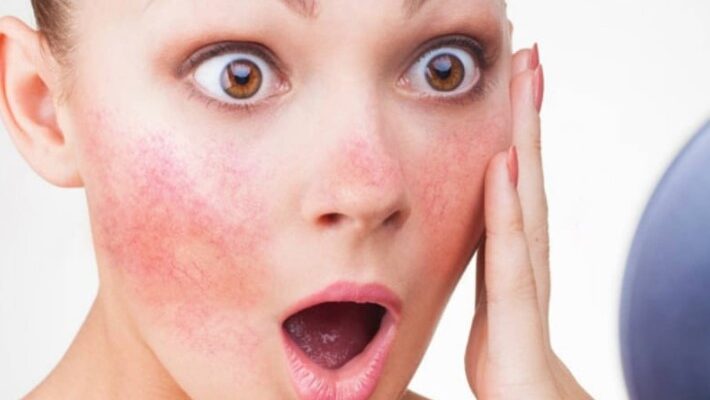Купероз: причини виникнення, симптоми та ефективні методи лікування