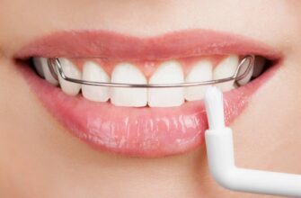 Ретейнери: Що Це Таке та Чому Вони Важливі для Вашої Усмішки?