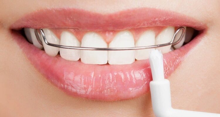Ретейнери: Що Це Таке та Чому Вони Важливі для Вашої Усмішки?