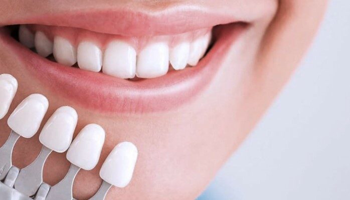 Вініри: Секрет до Ідеальної Усмішки та Як Їх Обрати Правильно