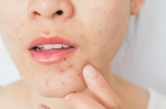 Що таке акне: причини, симптоми та ефективні методи лікування
