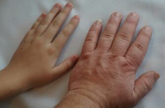 Акромегалія: Причини, Симптоми та Лікування Рідкісного Захворювання