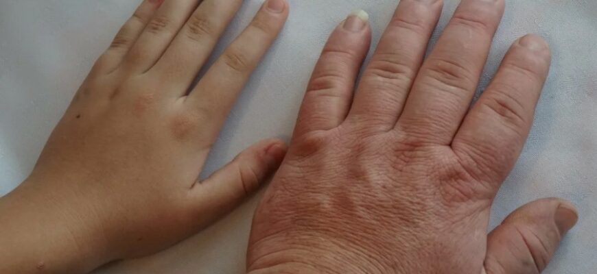 Акромегалія: Причини, Симптоми та Лікування Рідкісного Захворювання