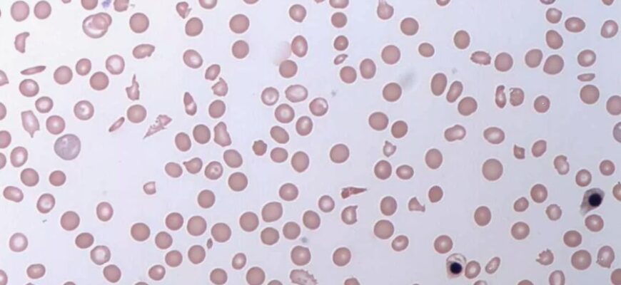 Апластична анемія: причини, симптоми та методи лікування захворювання