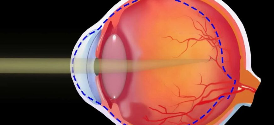 Астигматизм ока: причини, симптоми та методи корекції зору