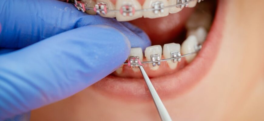 Брекети: Що це таке, види, переваги ортодонтичного лікування