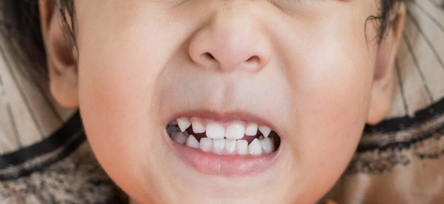 Що таке бруксизм: причини, симптоми та методи лікування захворювання