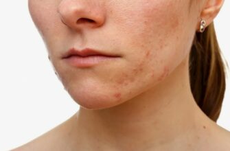 Причини, симптоми та лікування демодекозу: Повний огляд захворювання