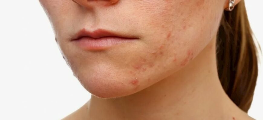 Причини, симптоми та лікування демодекозу: Повний огляд захворювання