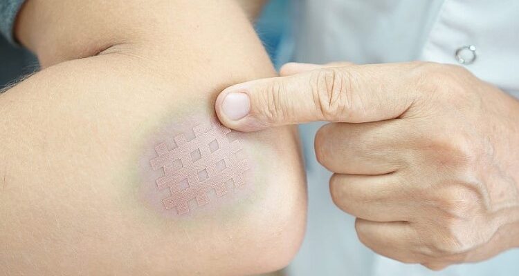 Гематома: визначення, причини виникнення та методи лікування