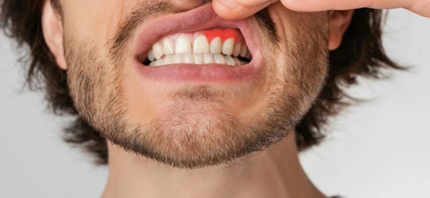 Гінгівіт: Причини, симптоми та ефективні методи лікування захворювання