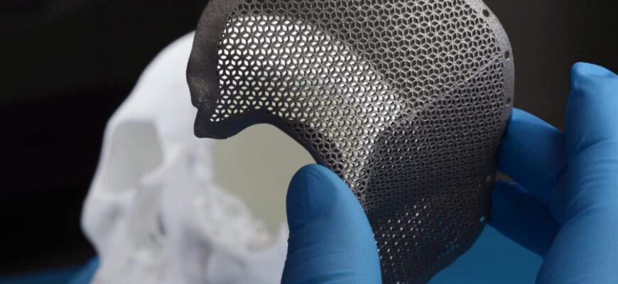 Що таке імпланти: все, що потрібно знати для вашого здоров’я