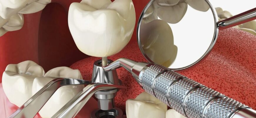 Зубні імпланти: Особливості, переваги та ключові факти для вас