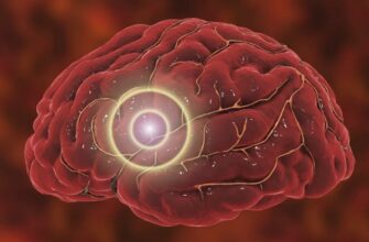 Інсульт: розпізнавання симптомів, причини та профілактика хвороби