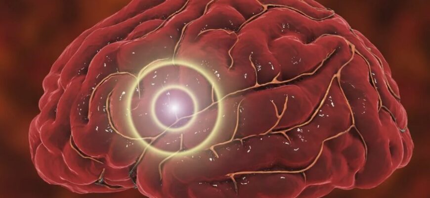 Інсульт: розпізнавання симптомів, причини та профілактика хвороби