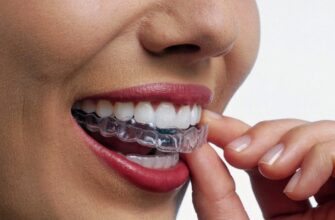 Захист зубів: Що таке капа та як вона допомагає зберегти вашу усмішку