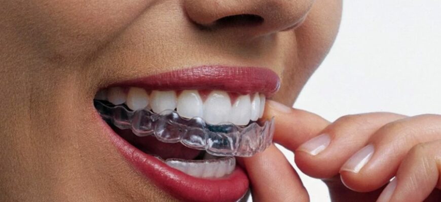 Захист зубів: Що таке капа та як вона допомагає зберегти вашу усмішку