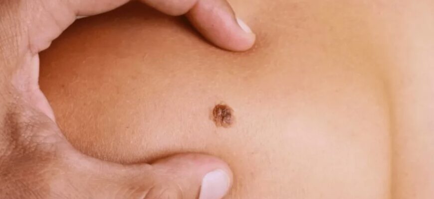 Що таке кератома: симптоми, причини та методи лікування шкірного утворення