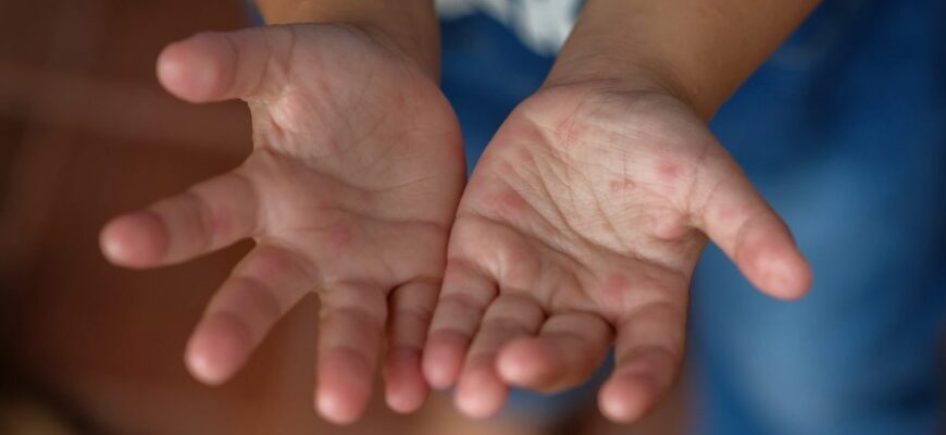 Що таке вірус Коксакі в дітей: симптоми, причини та лікування