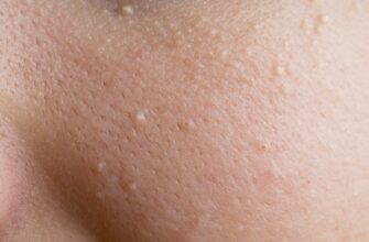 Комедони: що це таке, причини виникнення та методи лікування