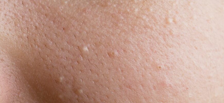 Комедони: що це таке, причини виникнення та методи лікування