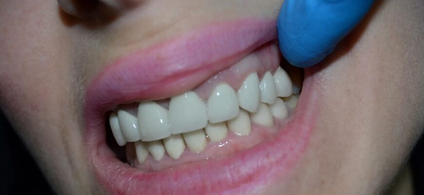 Коронка на зуб: Що це таке, види та переваги застосування