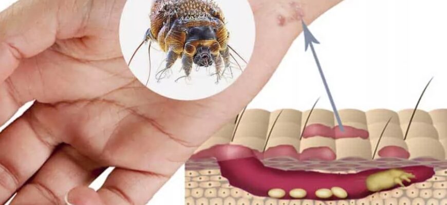 Короста: Причини, симптоми та ефективні методи лікування захворювання