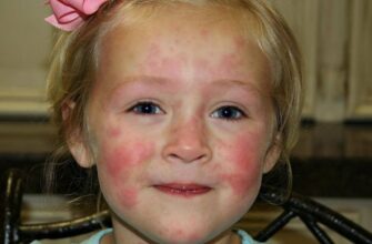 Кропивниця: Симптоми та причини. Як шкіра сигналізує про дисбаланс?