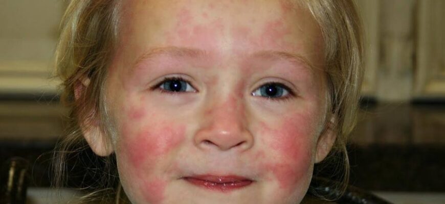 Кропивниця: Симптоми та причини. Як шкіра сигналізує про дисбаланс?