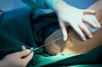 Ліпосакція: процес, види та переваги процедури для вашого тіла