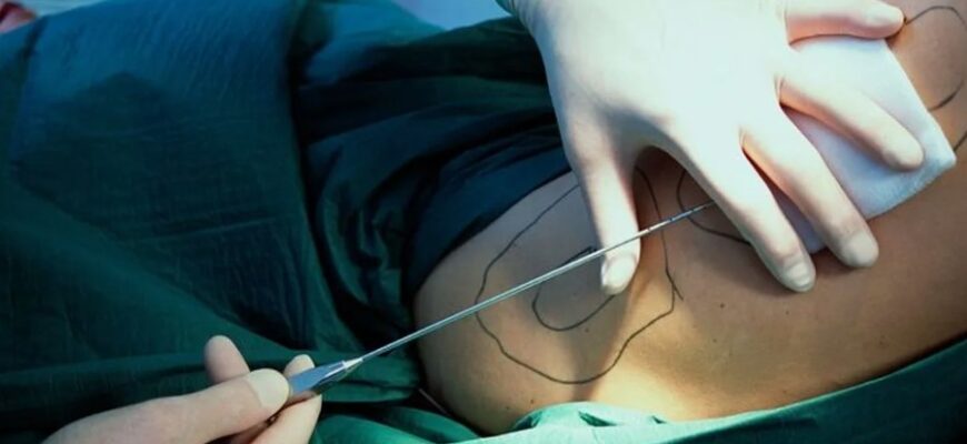 Ліпосакція: процес, види та переваги процедури для вашого тіла