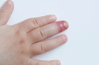 Панарицій: Симптоми, Причини та Ефективні Методи Лікування