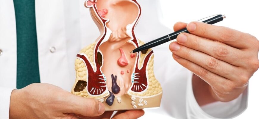 Парапроктит: Симптоми, Причини Та Методи Лікування Захворювання