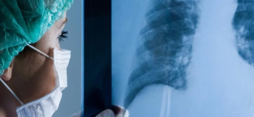 Що таке плеврит: причини, симптоми та методи лікування захворювання