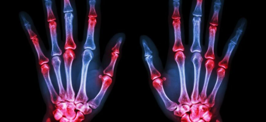 Поліартрит: Визначення, Причини та Симптоми Захворювання Суставів