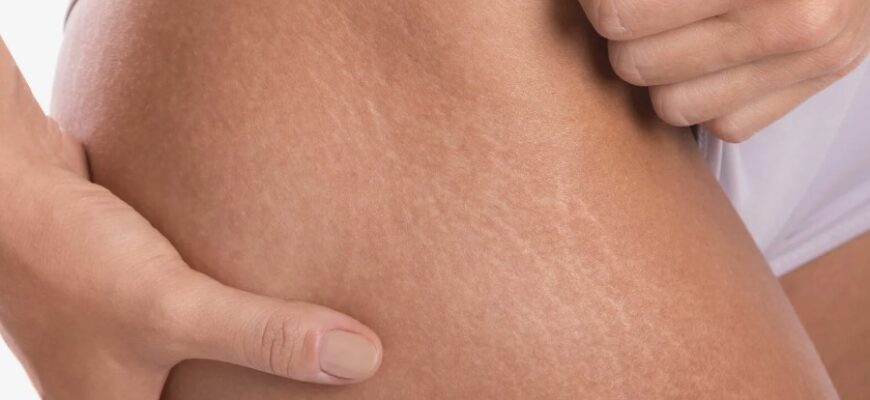 Розтяжки на шкірі: причини виникнення та ефективні методи боротьби