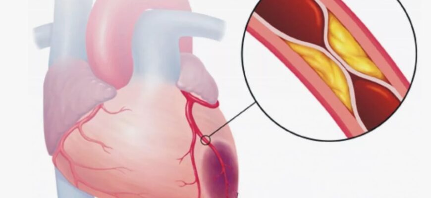 Стеноз: визначення, причини та методи ефективного лікування Стеноз: визначення, причини та методи ефективного лікування