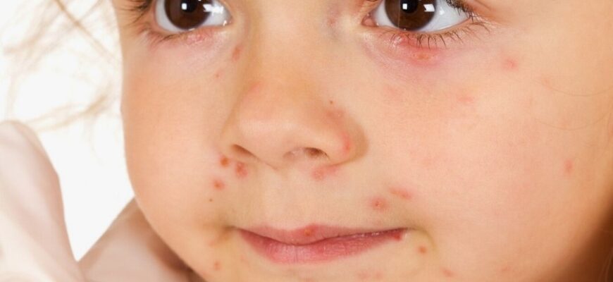 Все про стрептодермію: симптоми, діагностика і методи лікування