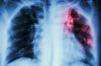 Що таке туберкульоз: симптоми, шляхи передачі та методи лікування