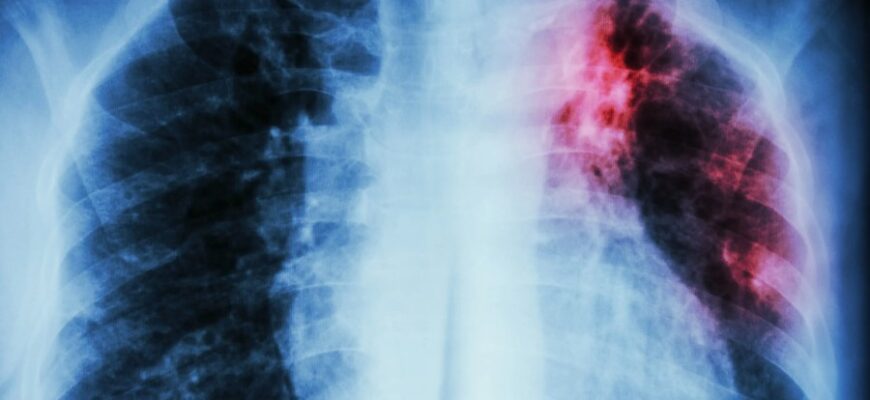 Що таке туберкульоз: симптоми, шляхи передачі та методи лікування