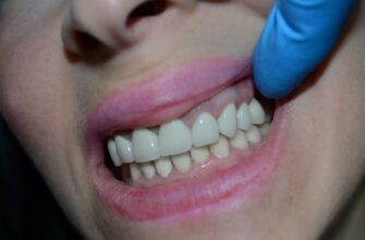 Що таке вініри: Переваги, процес встановлення та догляд