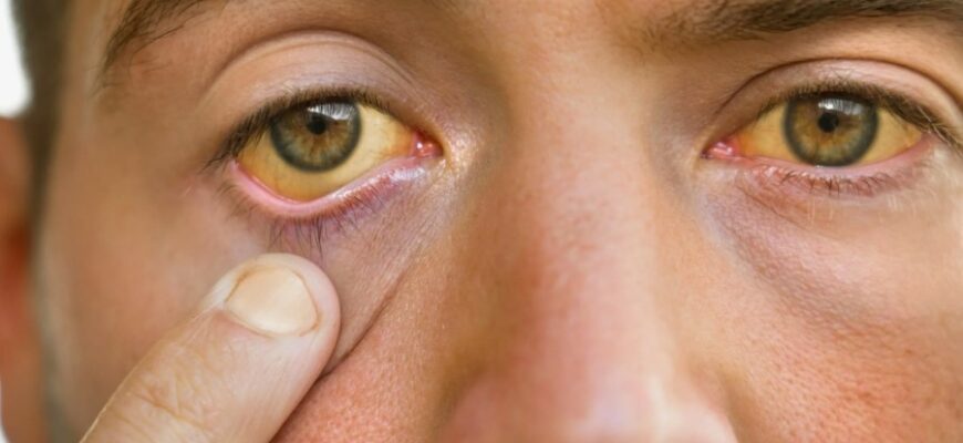 Жовтяниця: Причини, Симптоми та Лікування – Все, Що Потрібно Знати