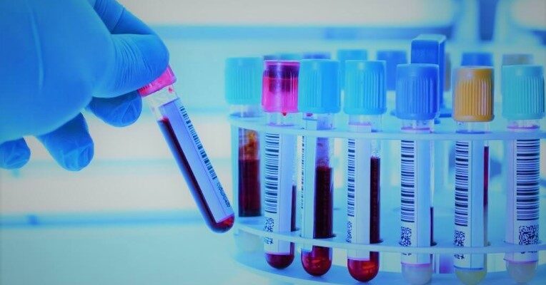 Швидкість осідання еритроцитів (ШОЕ): значення та медичні норми