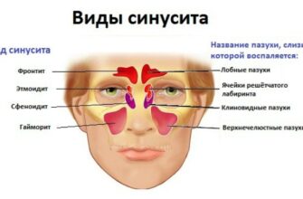 Синусит і гайморит: у чому різниця та як їх розрізняти?
