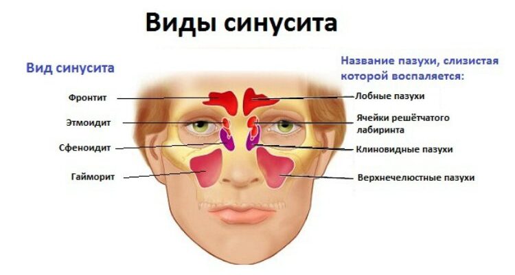 Синусит і гайморит: у чому різниця та як їх розрізняти?