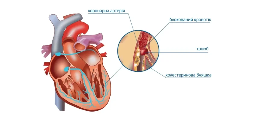 Грудна жаба: симптоми, причини та методи лікування стенокардії